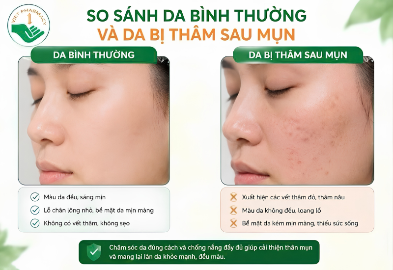 So sánh da bình thường và da bị thâm sau mụn